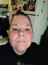 Good morning everyone I have rumatoyed arthritis since I was 5 yrs old and  I now have noticed this redness