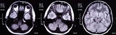 Poniższy artykuł omawia aspekty klinicznego zastosowania rezonansu magnetycznego w stwardnieniu rozsianym. Ostre Rozsiane Zapalenie Mozgu I Rdzenia Adem Neurologia Praktyczna