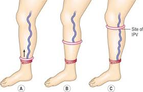 Image result for Perthes Test