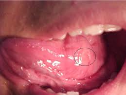 Image result for papillomavirus tongue)