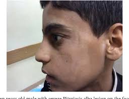 It must be remembered that discolored patches of pityriasis alba darken on prolonged exposure to sunlight. Figure 1 From Pityriasis Alba Versus Vitiligo Clinical And Histopathological Study Semantic Scholar