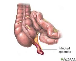 Hie Multimedia Appendectomy