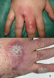 Image result for Hand Infection