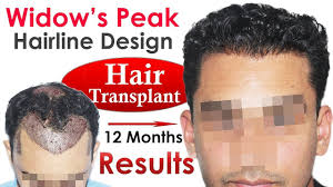 New Hair Transplant Widows S Peak Hairline Design At Medispa India Jaipu Hair Transplant Hair Transplant In India Widow S Peak