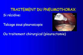 J'ai subi un talcage pleural par thoracoscopie vidéo assistée il y a quelques années (opération consistant à coller les plèvres qui entourent le poumon) suite à un pneumothorax récidivent (opération. Pathologie Pleurale L Lucaci Centre Hospitalier De Lens Ppt Video Online Telecharger