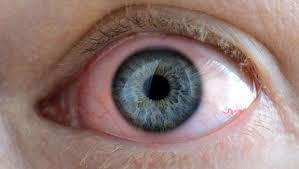 Gozde Kirmizilik Niye Olur Gozlerdeki Kirmizilik Hastalik Belirtisi Mi