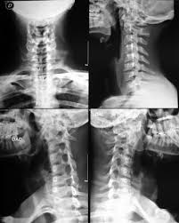 This knowledge should help clinicians to identify patients in need for extra surveillance and gives insight to further studies on the mechanisms of metastasis. Pin De Yasmine Anchen En 2014 Mod A Tp 6 Radiografia Radiologia Columna Lumbar
