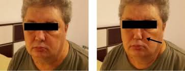 The Importance of Appropriate PAP Silicone Mask Selection in Sleep Apnea  Management