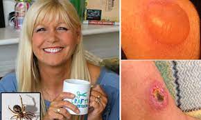Possible causes, signs and symptoms, standard treatment options and means of care and support. False Widow Spider I Didn T Even Realise It Was A Spider Bite Daily Mail Online
