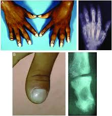 Image result for Dactylitis