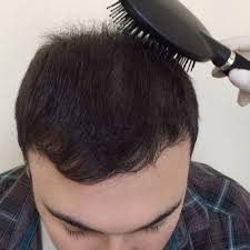 Sac Ekimi Sacekimi Ankara Sac Ekim Merkezi Hairtransplantationturkey Http Turkrazzi Com Ipost 1515277945474874313 In Ear Headphones Ear Over Ear Headphones