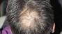 Alopecia Hair Falling Out
