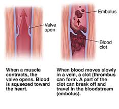 Understanding Deep Vein Thrombosis