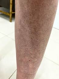Image result for Keratosis pilaris