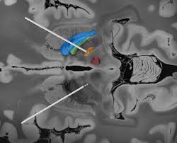 D.b.s., a canadian punk rock band from 1992 to 2001. Lead Dbs A Matlab Toolbox Reconstruction And Visualization Of Dbs Electrodes Based On Postoperative Imaging