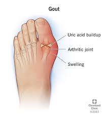 Image result for gout symptoms knee