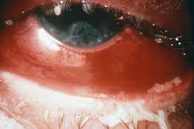 Image result for Gonococcal Conjunctivitis