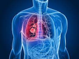 Lung Cancer Symptoms, Risk Factors, Diagnosis And Treatment | Narayana  Health