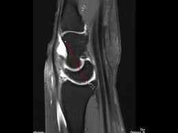 Image result for Scapholunate Dislocation