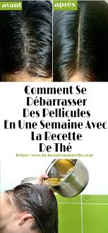 Coucou Mes Jolies Si Vous Avez Marre Des Pellicules Qui Gachent Votre Vie Voila La Solution Radicale Pour S En Debarrasser Hair Care Hair Beauty Dandruff