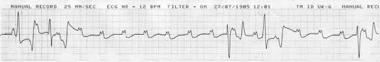 This is known as an escape rhythm. Heart Atrioventricular Block 3rd Degree Horses Vetlexicon Equis From Vetlexicon Definitive Veterinary Intelligence