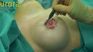 Areola reduction surgery is a relatively simple procedure that can reduce the diameter of one or both of your areolas. Areola Reduction Surgery From 7 5cm Diameter To Less Than 4cm Aurora Clinics Youtube