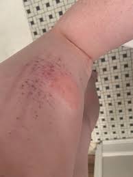 Bad reaction to mosquito bite - whats the purple dots?? Have always been  allergic but never had such a severe reaction … : rmedical