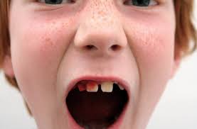 A quick visit to your pediatric dentist in erdenheim can make pulling a loose tooth easy and is the classic: How To Pull A Tooth Without Golf Clubs Rockets Or Doorknobs Beautiful Smiles Family Dental Center