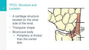 The tfcc is at risk for either acute or chronic degenerative injury. Triangular Fibrocartilage Complex Tfcc Ppt Download