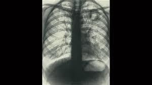 Image result for Chest XRay