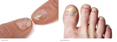 Image result for mykoza nehtů