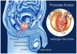 Prostate cancer is a malignancy of the prostate gland and is one of the most common cancers of the male reproductive system. Five Early Signs Of Prostate Cancer Should Not Be Ignored Healthmedicinentral