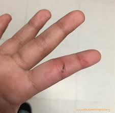 Jul 19, 2020 · without tweezers baking soda:. Digging Out Splinters Two Peds In A Pod