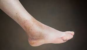 Avoid salty foods and processed foods before you go to bed (and in general). Swollen Ankle And Leg Causes Treatments And More