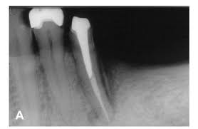 Gupta h, puri a, kumar s. Scielo Brasil Cemental Tear A Case Report With Nonsurgical Periodontal Therapy Cemental Tear A Case Report With Nonsurgical Periodontal Therapy