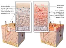 Neurodermitis ist eine hautkrankheit, die v.a. Neurodermitis Gesundheitsinformation De