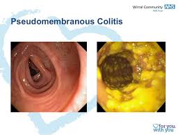 Difficile that occurs primarily among individuals who have been. Clostridium Difficile A Community Perspective