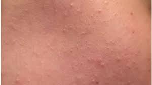 Comedones Guia De La Piel Dermatologos En Linea