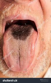 Image result for black hairy tongue symptoms