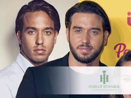 James Lock Hair Transplant: Revealing His New Look