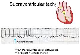 Paroxysmal Tachy Png 1152 802 Nursing Jobs Medical Pictures Nurse