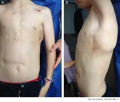 A fully subcutaneous icd (sqicd) has a can and lead that are placed subcutaneous but outside of the thorax. Totally Subcutaneous Implantable Cardioverter Defibrillator In A Child With Complex Congenital Heart Disease And Infection In A Previous Transvenous System Revista Espanola De Cardiologia