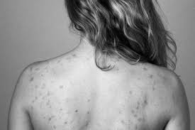 Image result for Keratosis pilaris