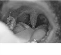 Disease Presentations Of The Uvula 2014 07 13 Ahc Media Continuing Medical Education Publishing
