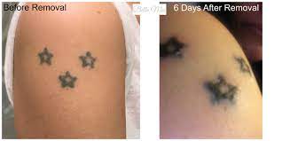 Apply a mixture of salt and lemon to remove the tattoo. Salt And Saline Tattoo Removal Tattoo Designs For Women Tattoos Tattoo Removal