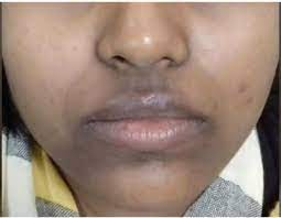 Penampilanmu terganggu karena bibir yang hitam dan juga kering? Hilangkan Lingkaran Gelap Sekitar Bibir Dengan Tepung Beras