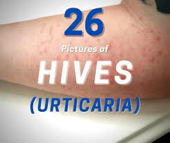 Pin On Hives And Allergies