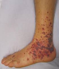 Small purpura spots are called petechiae, and larger spots are called eccymoses. Purpura Types Causes Diagnosis And Treatment