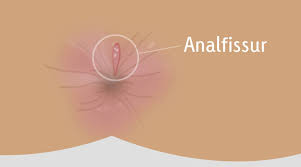 قابلة للتحويل السابق ملائم طريقة تنظيف الشرج comertinsaat com