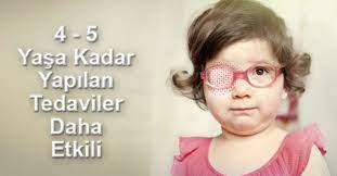 Goz Tembelligi Tedavisi Nasil Yapilir Optik Gazete